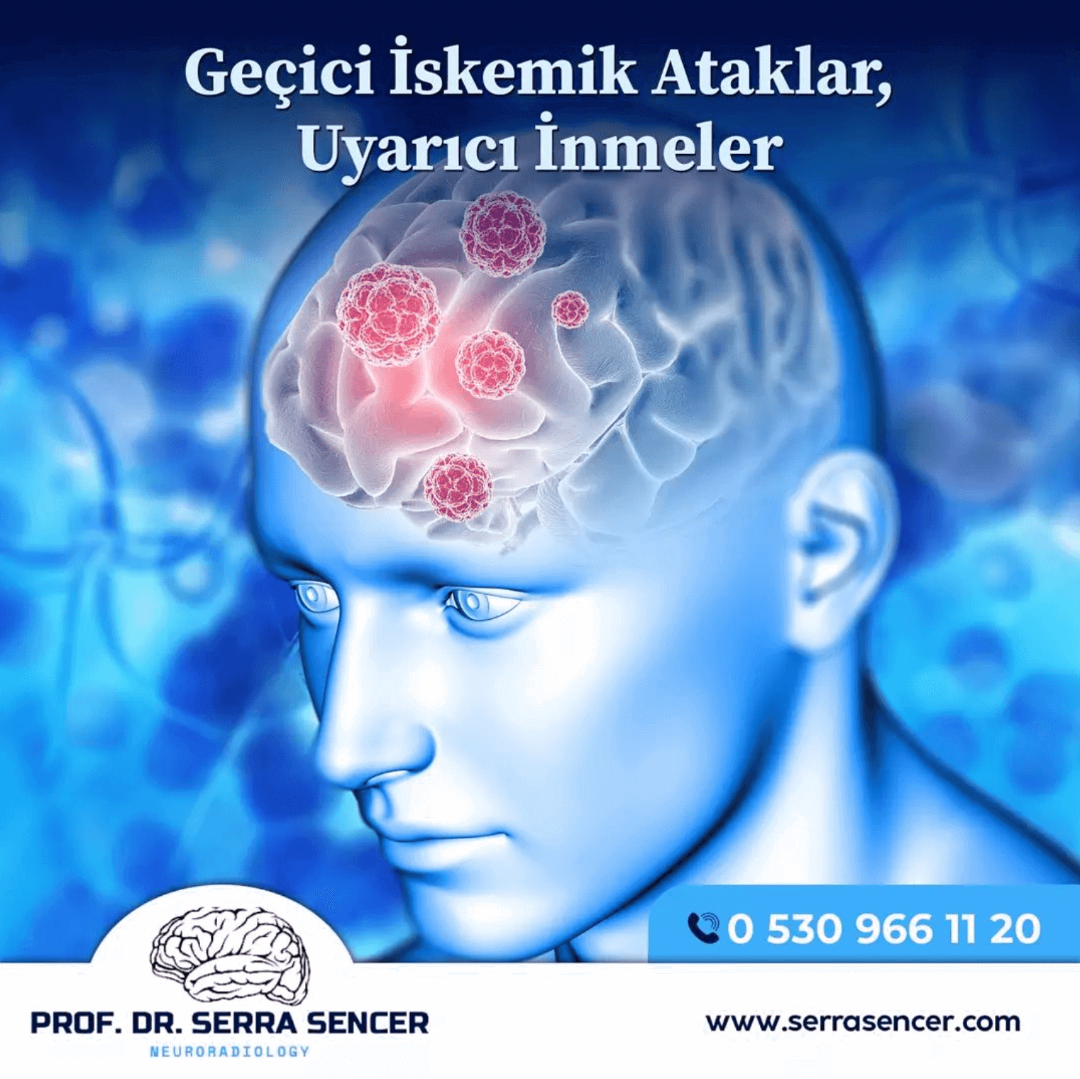 Geçici İskemik Ataklar, Uyarıcı İnmeler